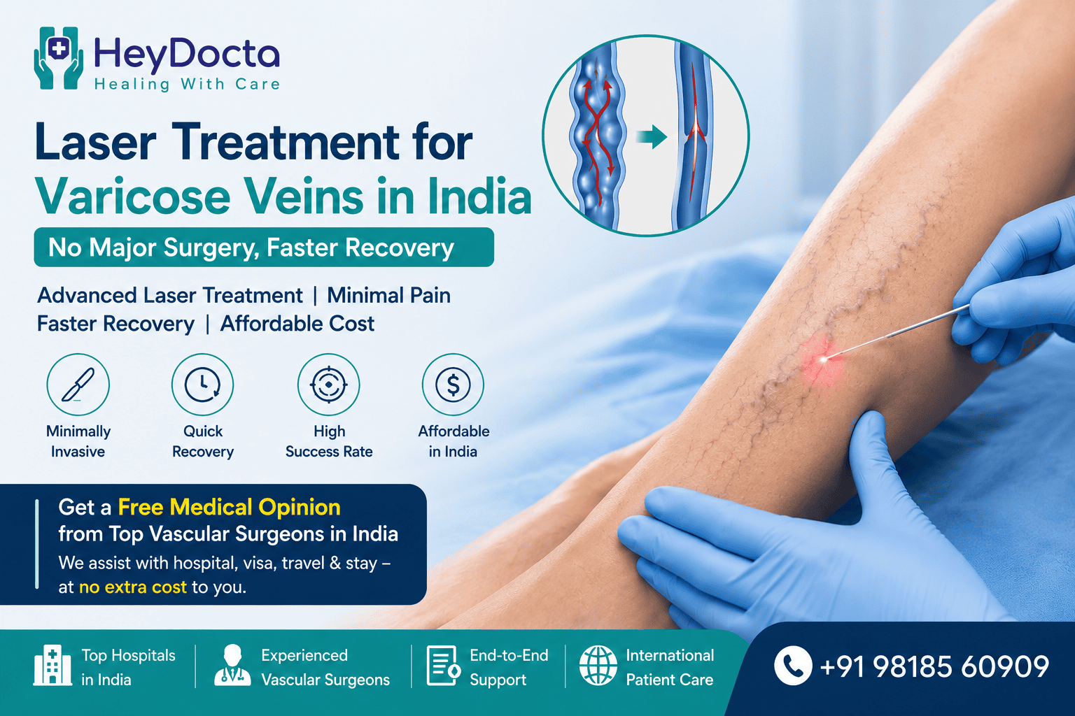 Laser Treatment for Varicose Veins in India, No Major Surgery, Faster Recovery