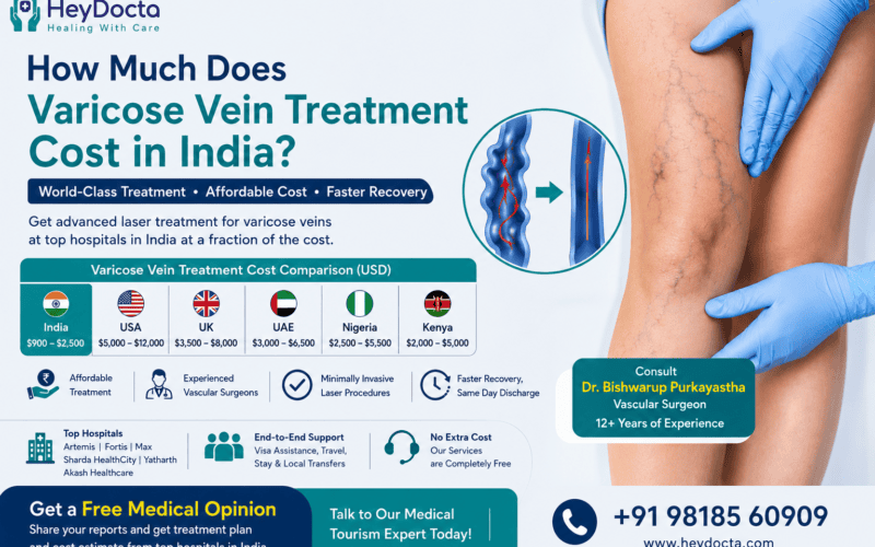 How Much Does Varicose Vein Treatment Cost in India?