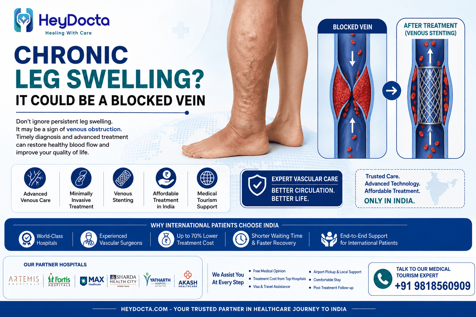 Chronic Leg Swelling? It Could Be a Blocked Vein