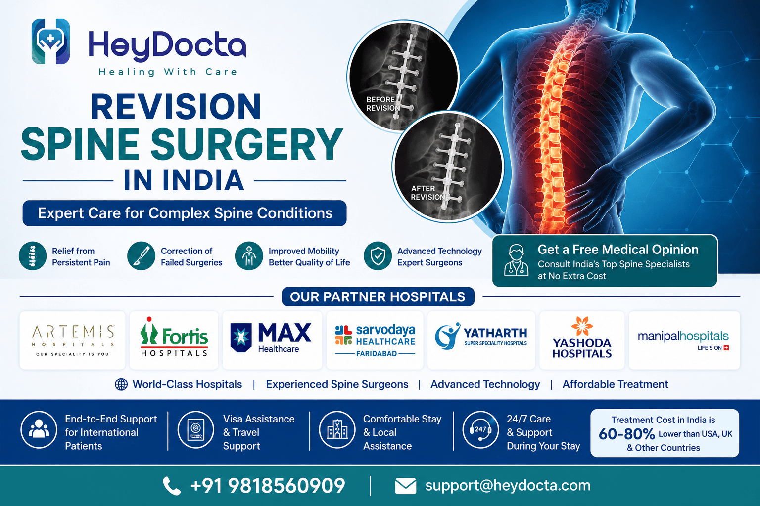Revision Spine Surgery in India