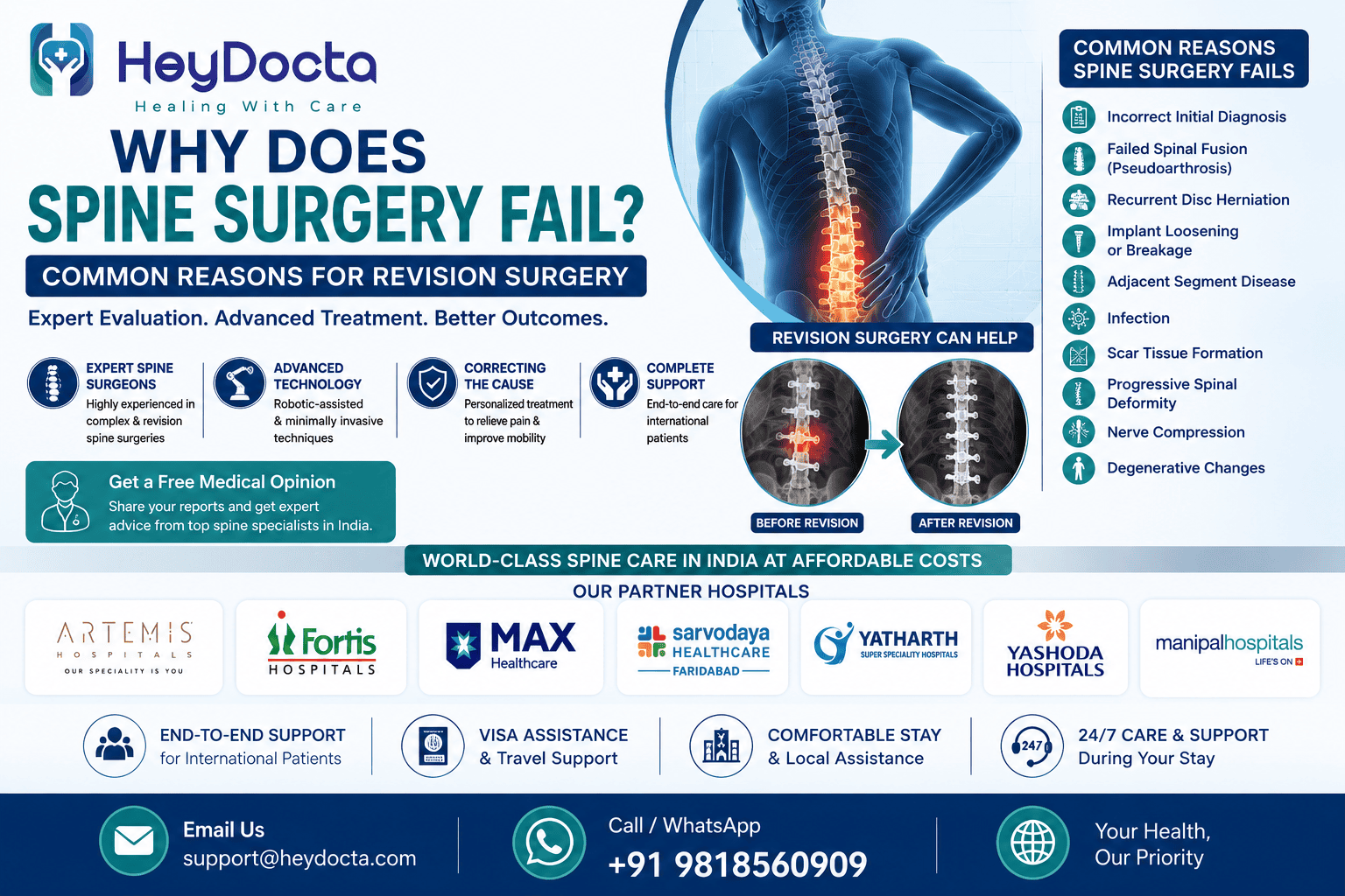 Why Does Spine Surgery Fail? Common Reasons for Revision Surgery