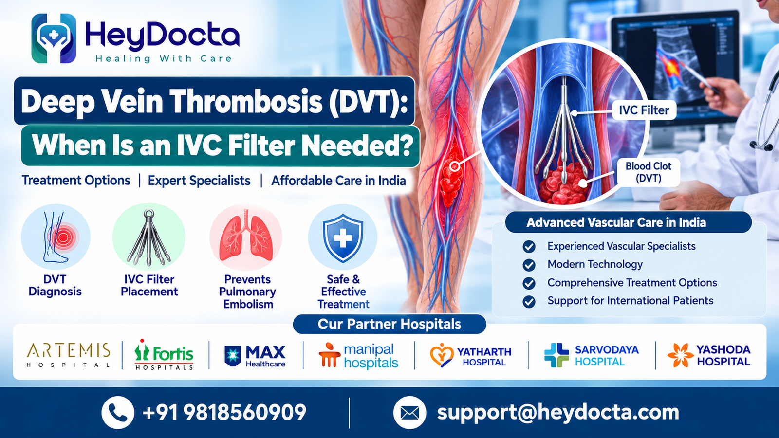 Deep Vein Thrombosis (DVT): When Is an IVC Filter Needed?
